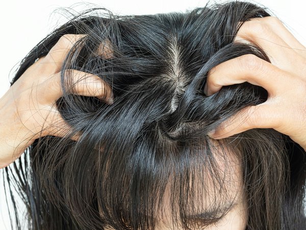 Psoriasis : les bienfaits potentiels du chanvre